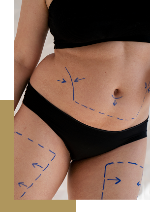 Abdominoplastia Antes e Depois Abdominoplastia Antes e Depois