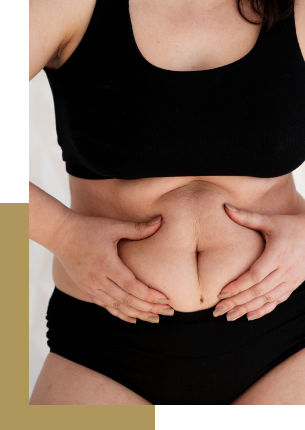 Abdominoplastia corrige diástase abdominal