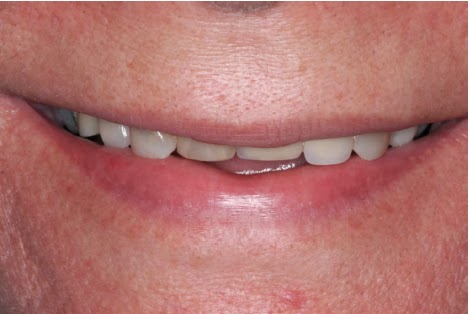 Perda da tonicidade muscular peri-labial em paciente idosa. Notar a diminuição na quantidade visível dos dentes.